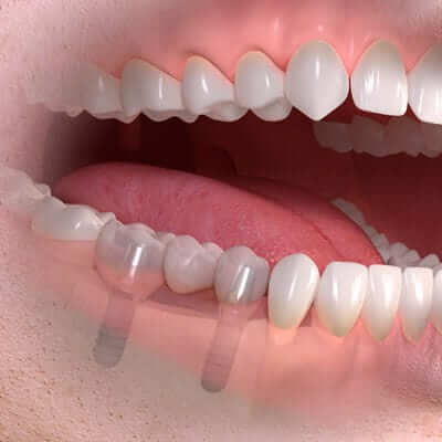 Dental Implants - implant borne multi tooth treatment