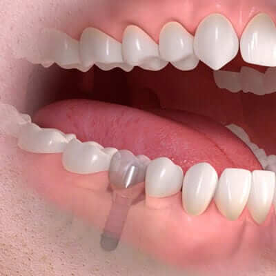 Dental Implants - implant borne single tooth treatment