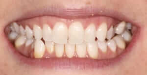 Invisalign Treatment in Knowle Solihull and Sutton Coldfield