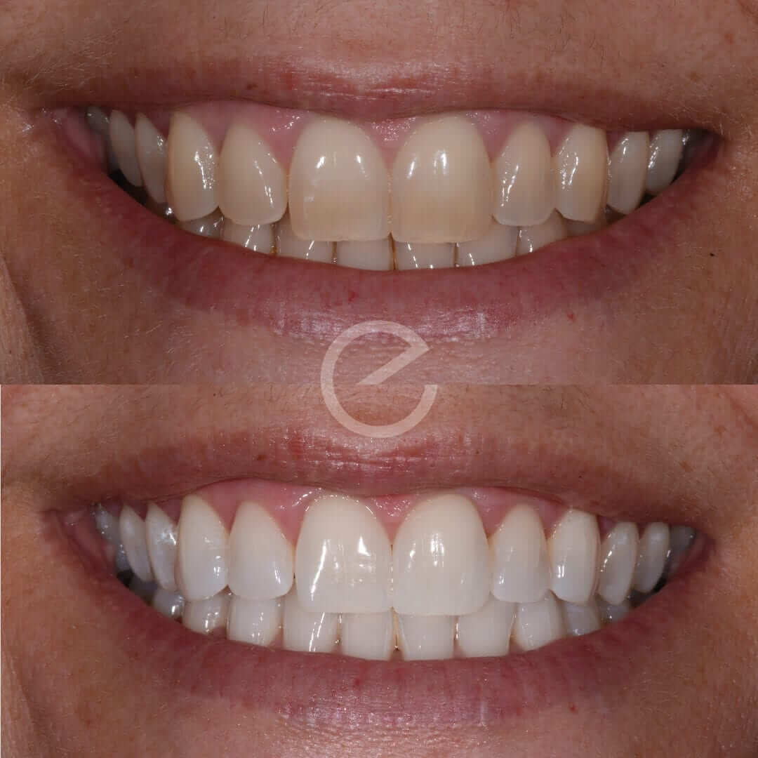 Enlighten teeth whitening solihull